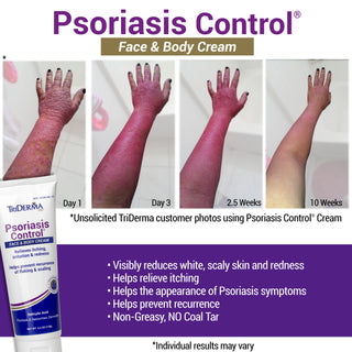 Psoriasis Control Face & Body Cream — 3% Salicylic Acid Relief for Itching, Flaking & Redness
