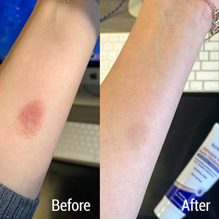 Genuine Aloe Burn Ointment Maximum Strength Topical Burn Relief